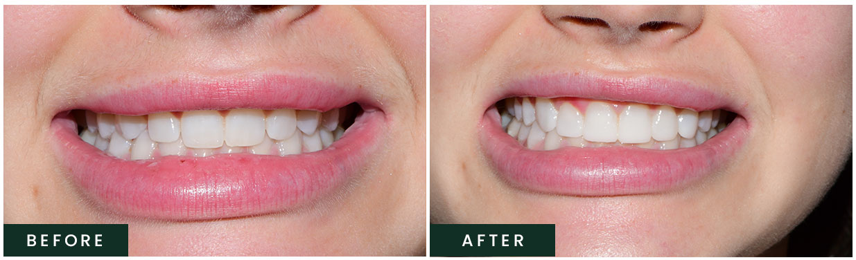 Before and After Gummy Smile Treatment in Weatherford