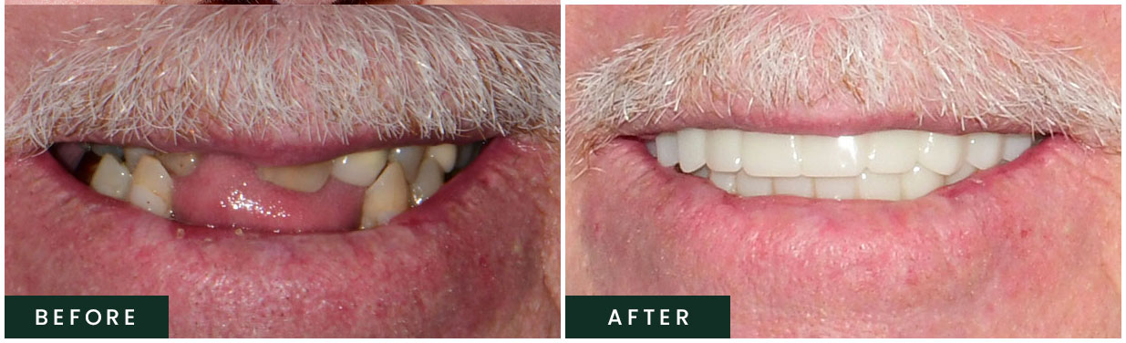 Before and After Teeth Whitening Transformation  