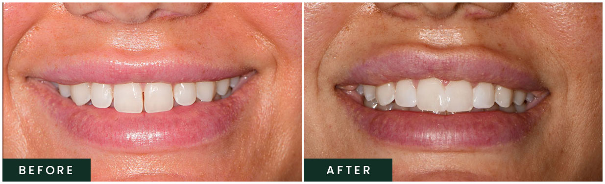 Before and After Teeth Whitening Transformation  