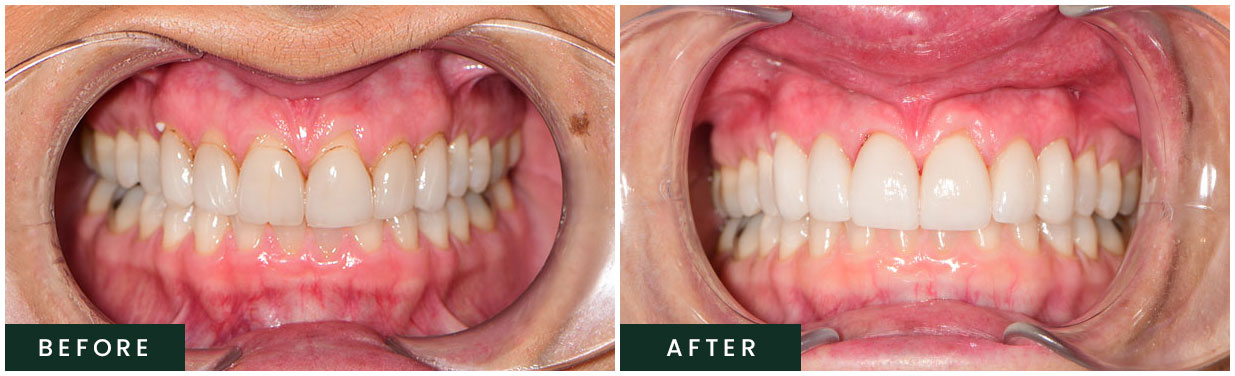 Before and After Teeth Whitening Transformation  