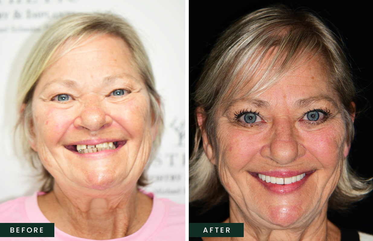 Before and After All-on-4 Dental Implants – Amazing Results!