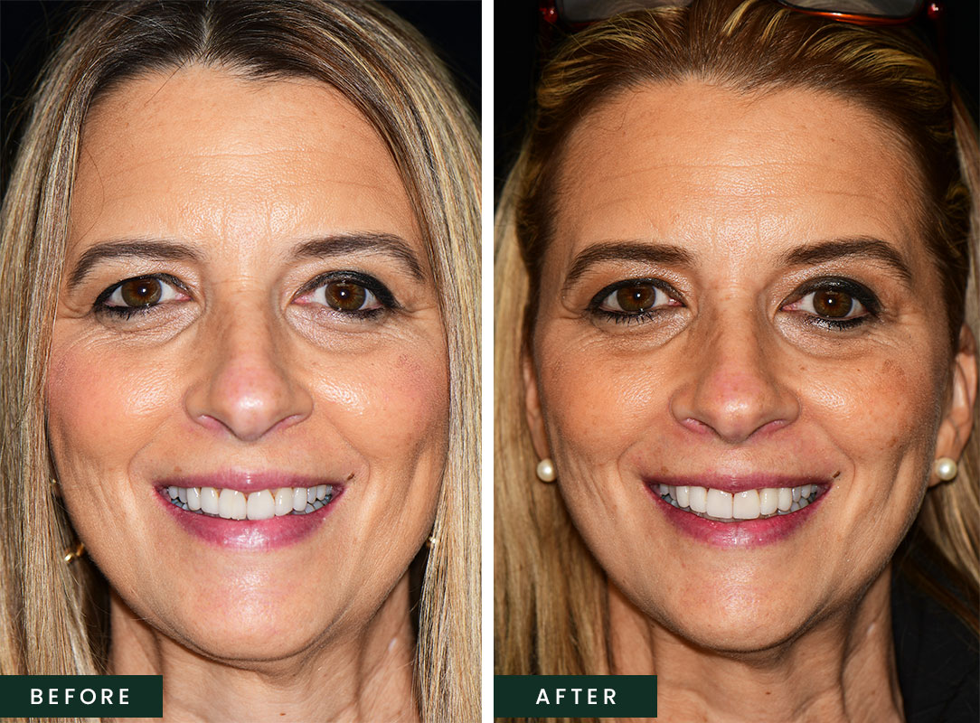 Gingivectomy and No Prep Veneers: Before and After